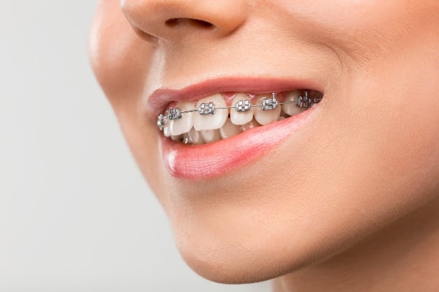 Little Smiles, Big Changes: Pediatric Braces